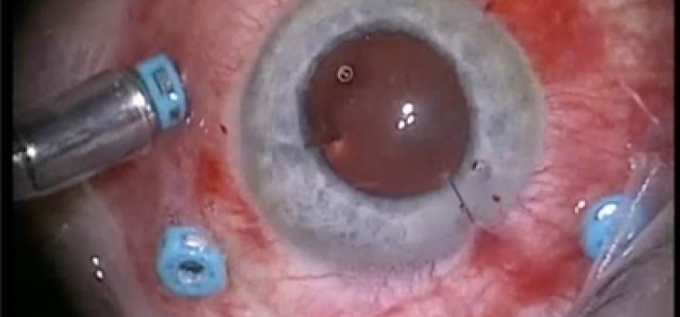 Vitrektomi-Retina Ameliyatı Nedir?