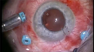 Vitrektomi-Retina Ameliyatı Nedir?